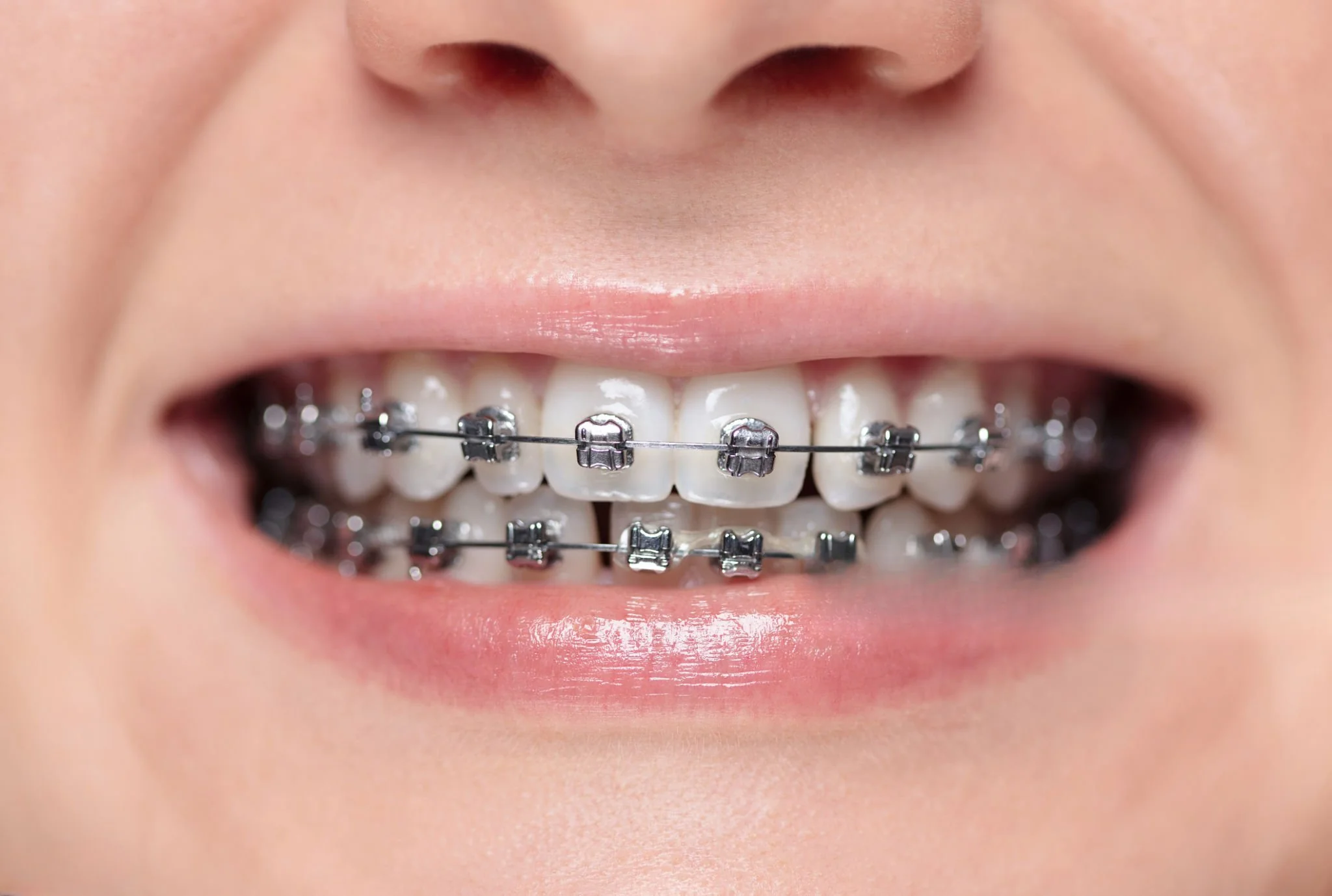 Traditional Metal Braces