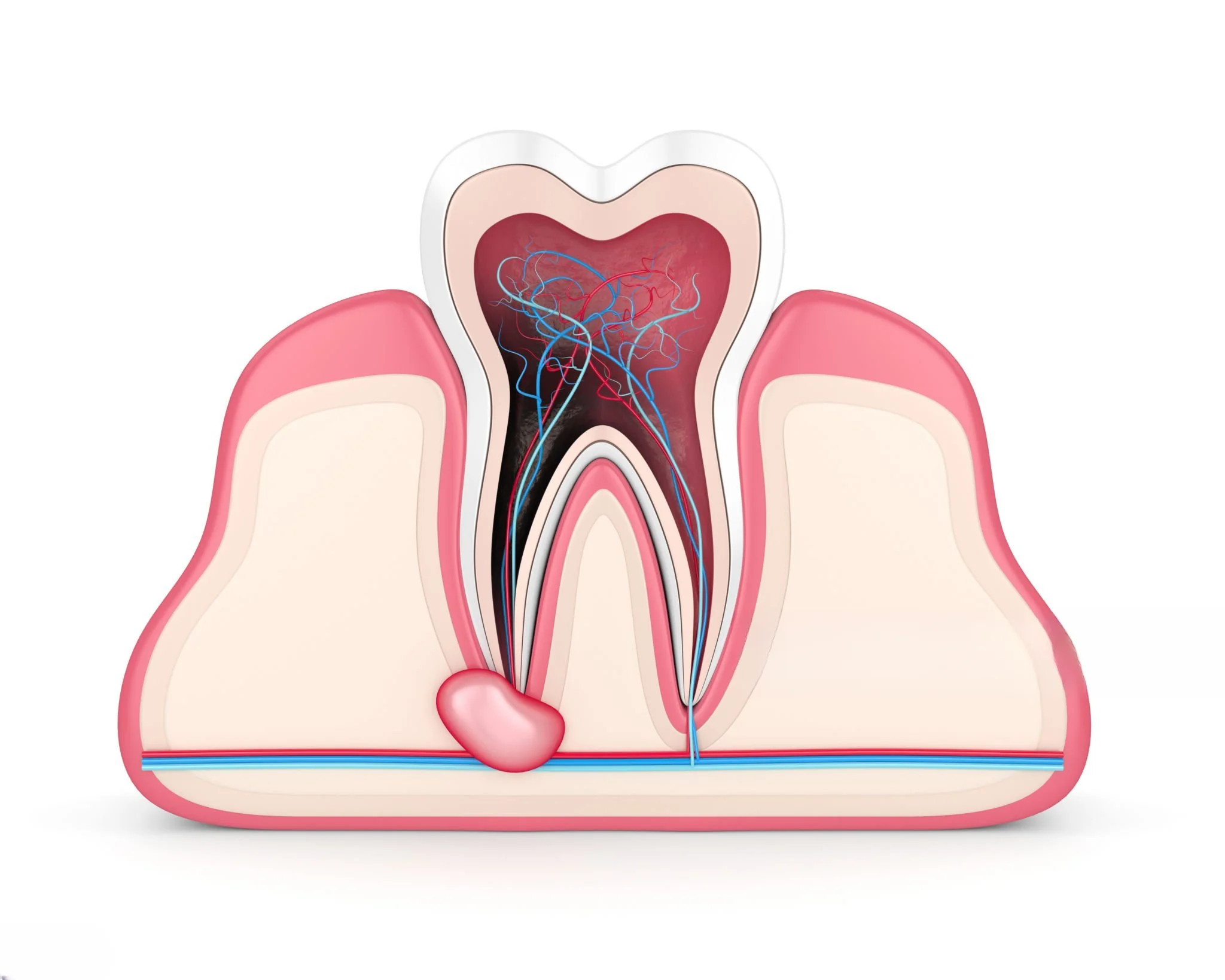 Oral Cyst Enucleation