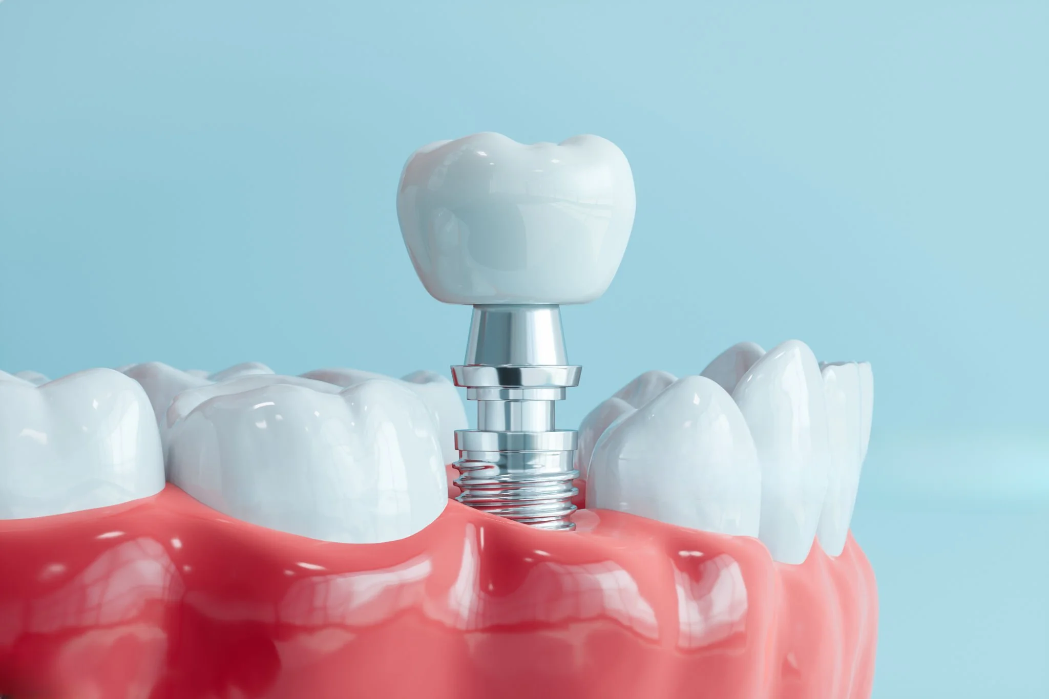 Dental Implants