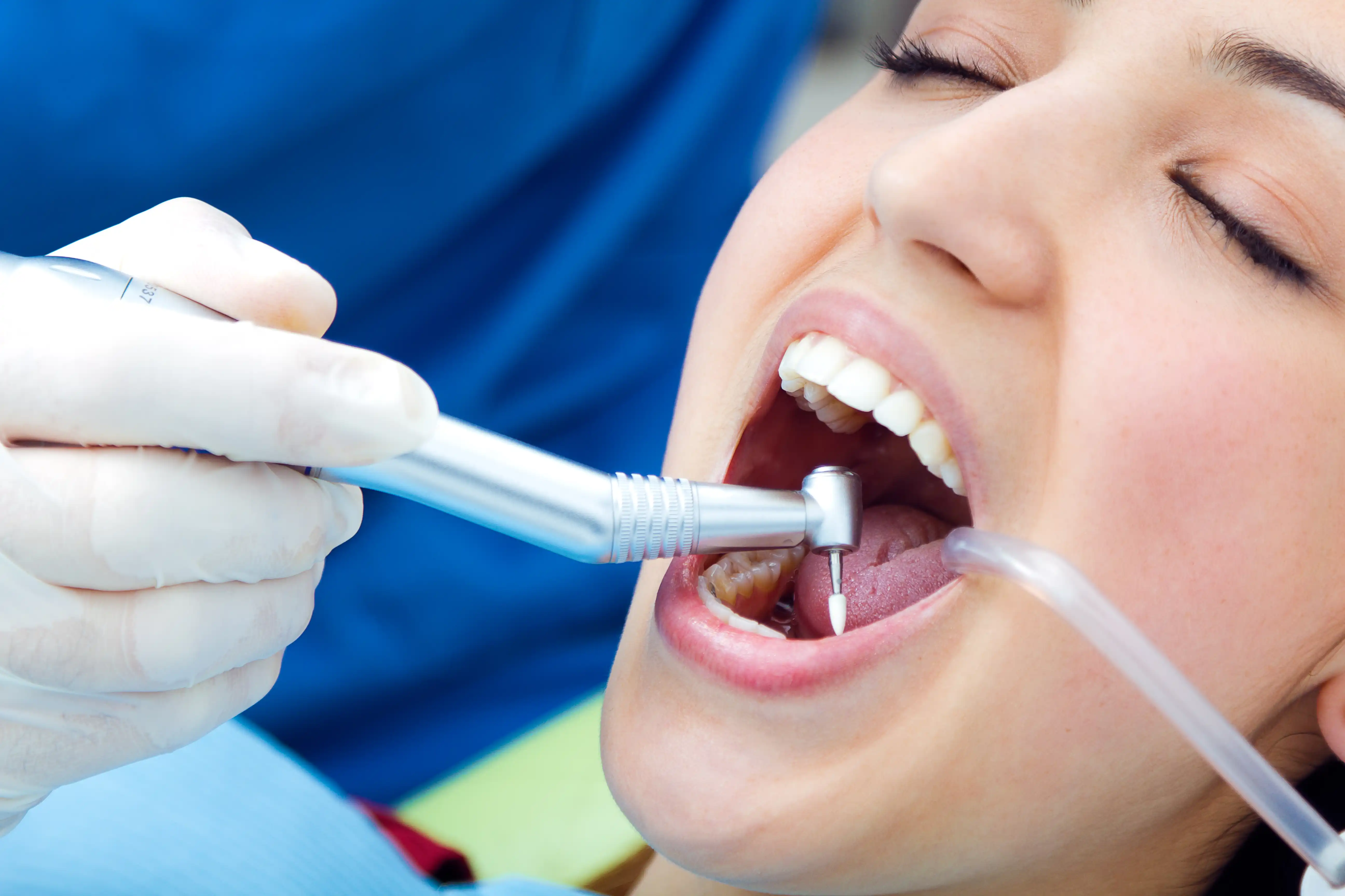 Fluoride Application