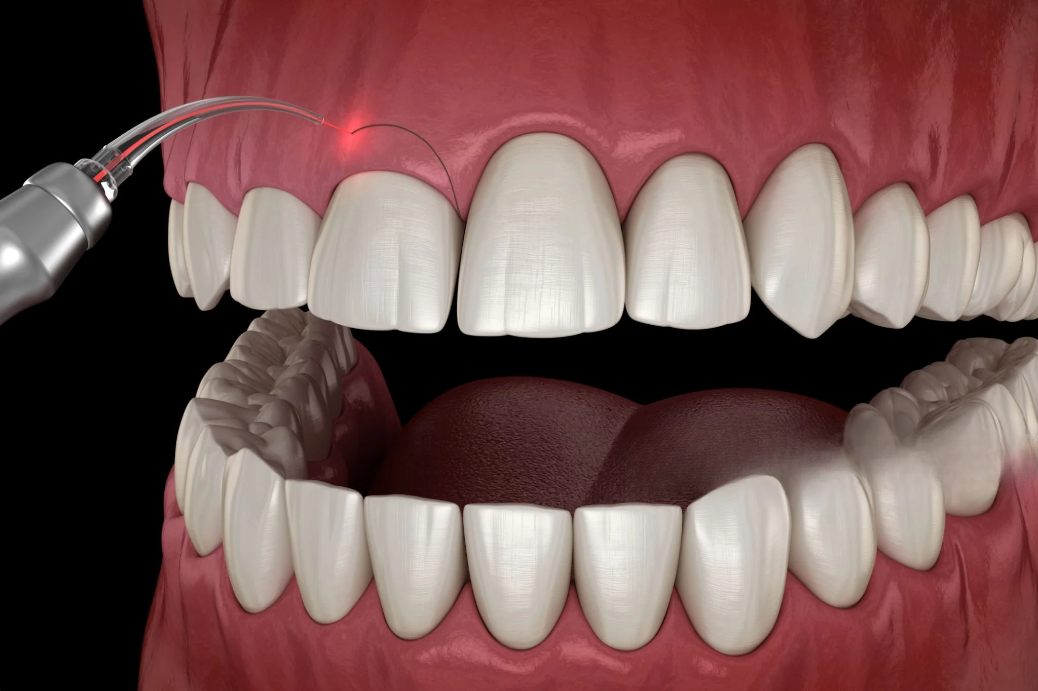 Gingivectomy
