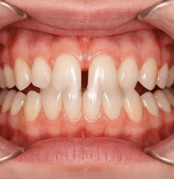 Midline Diastema Closure