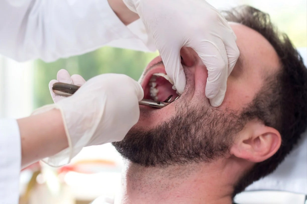 Simple Tooth Extraction
