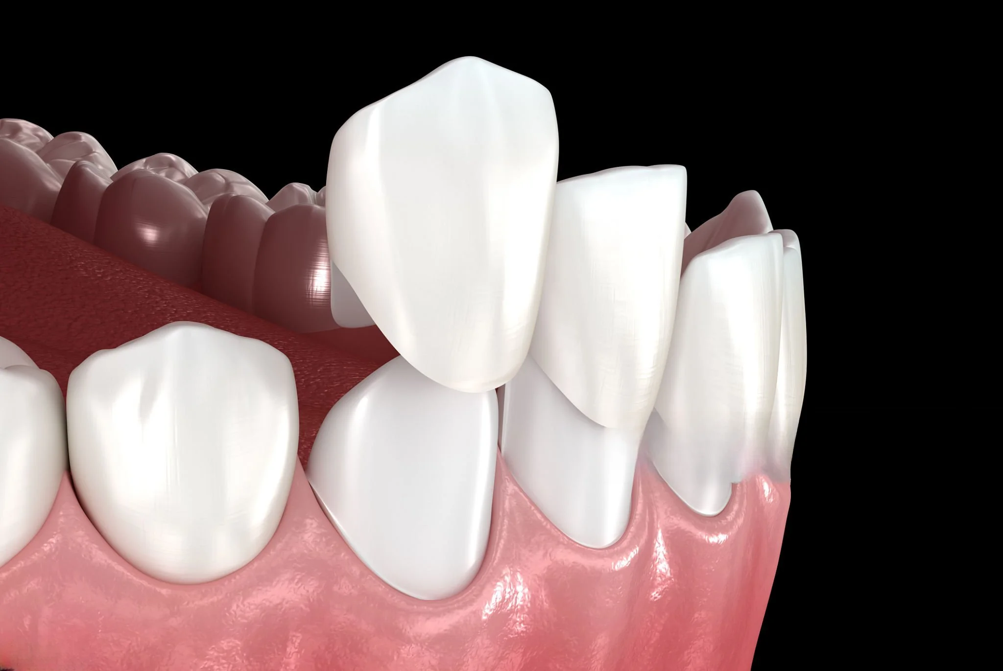 Dental Veneers